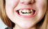 बच्चों-के-दांत-टेढ़े-crooked-teeth-prevention